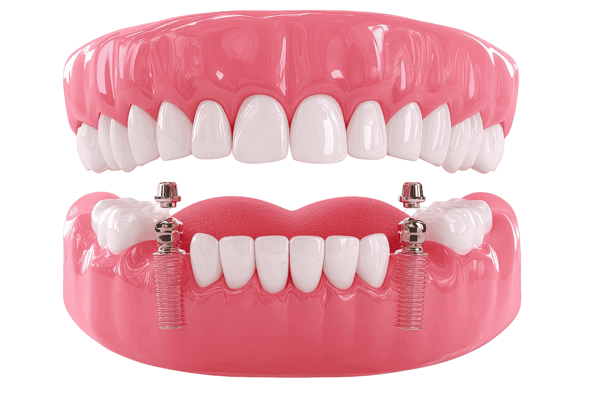 Implant Dentures